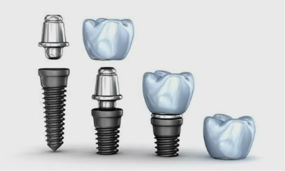 implantes dentales en Vélez-Málaga y Torre del Mar Clínica Dental Antonio Martínez