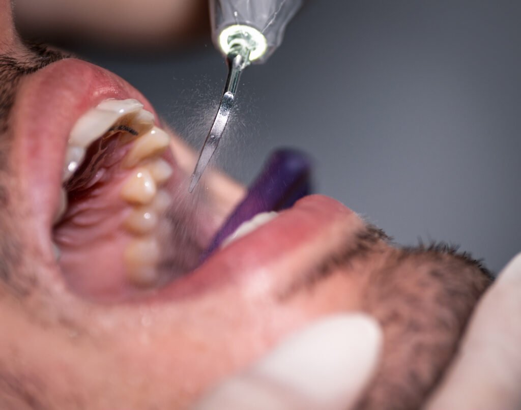 LIMPIEZA DENTAL ANTONIO MARTINEZ CLINICA DENTAL