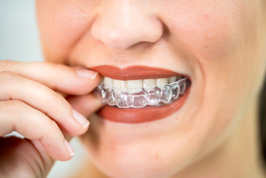 ORTODONCIA INVISIBLE